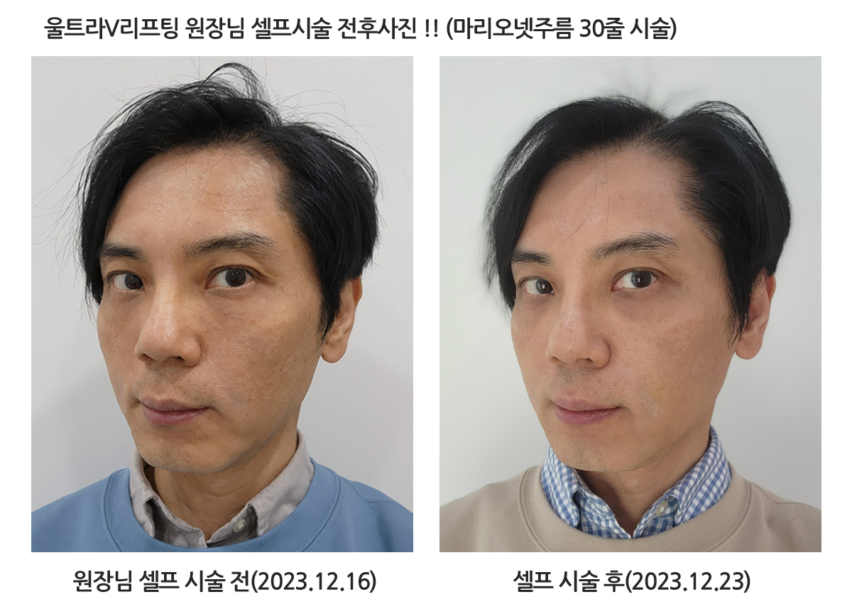 울트라V · 회오리 상세 안내 이미지 1